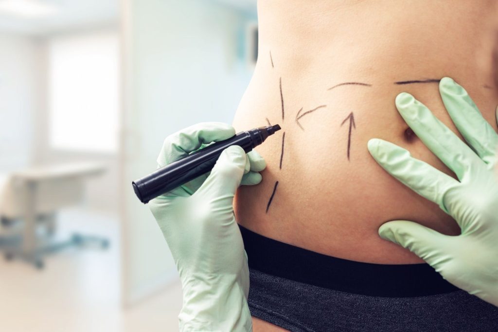 Enhancing beauty safely- benefits of Sono Bello’s laser liposuction